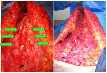 Abdominal Diastasis