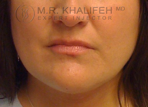 Lip Fillers  Dr. Khalifeh