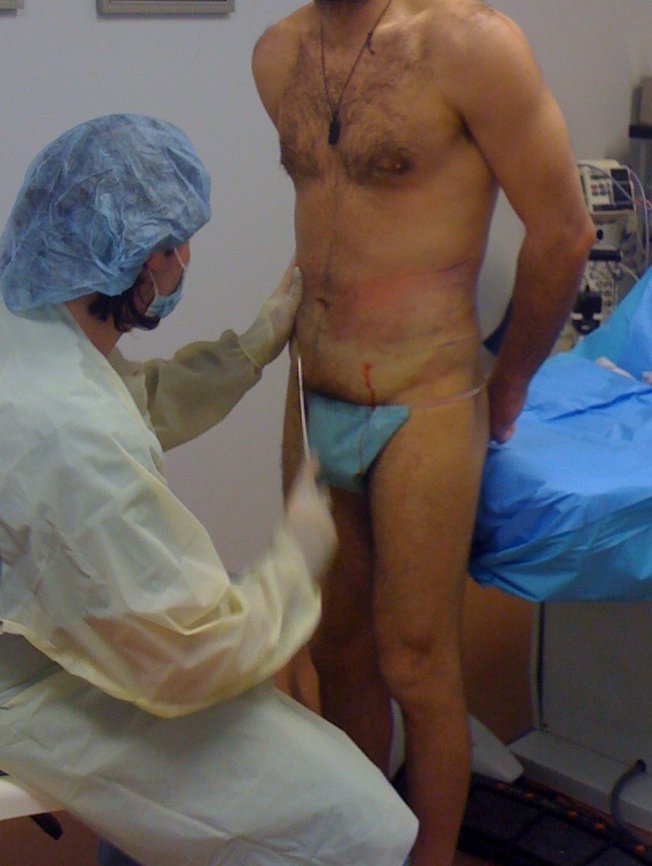 Laser Liposuction Standing Up