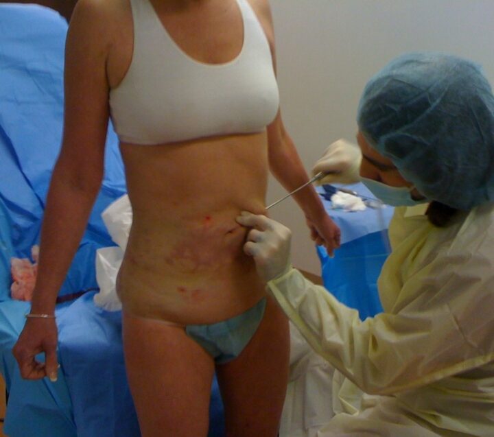 Laser Liposuction Standing Up