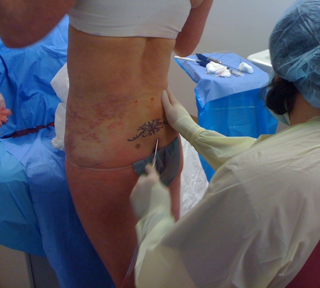 Laser Liposuction Standing Up