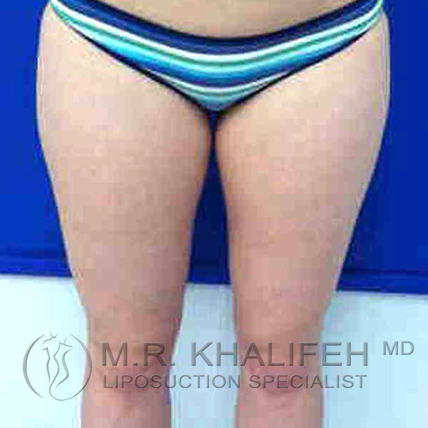 Inner Thigh Liposuction