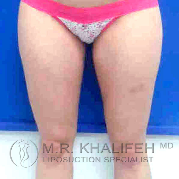 Inner Thigh Liposuction