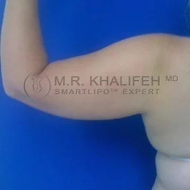 Arm Liposuction