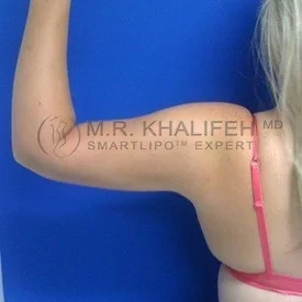 Arm Liposuction