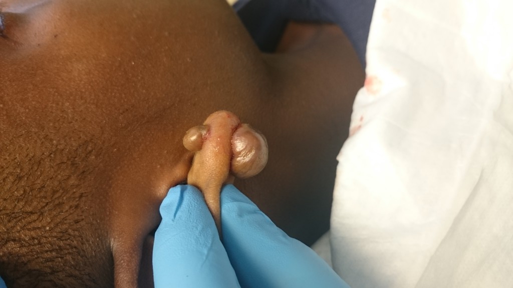 Keloid Scar Removal