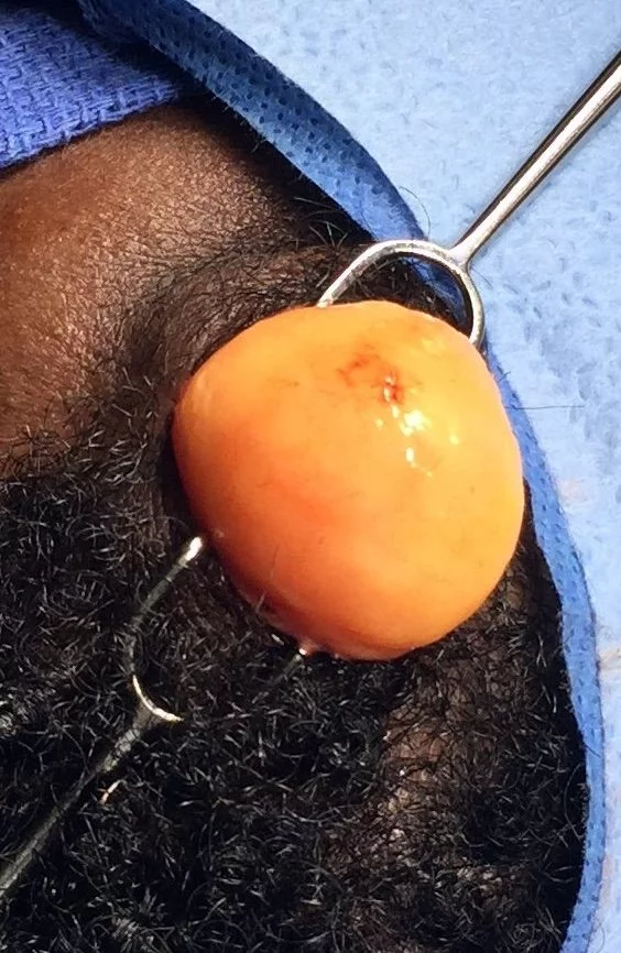 Lipoma Removal