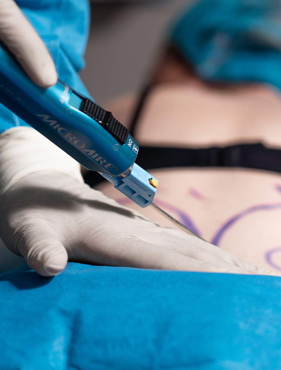 Laser Liposuction