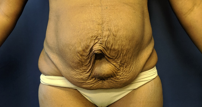 Advanced Techniques in Tummy Tuck Surgery