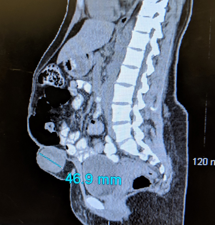 Advanced Techniques in Tummy Tuck Surgery