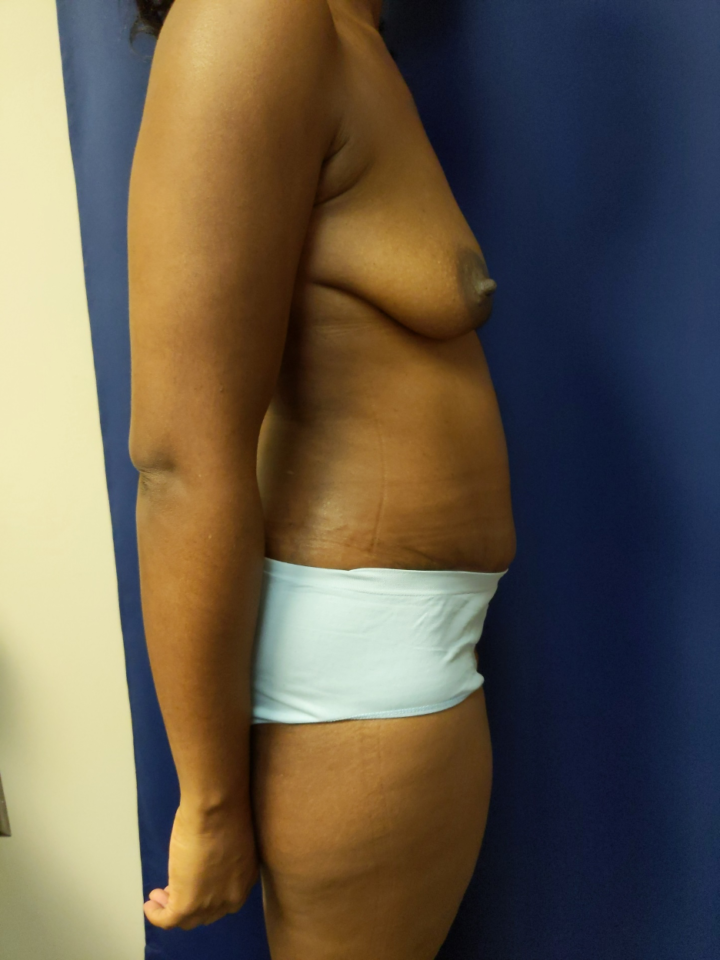 Advanced Techniques in Tummy Tuck Surgery