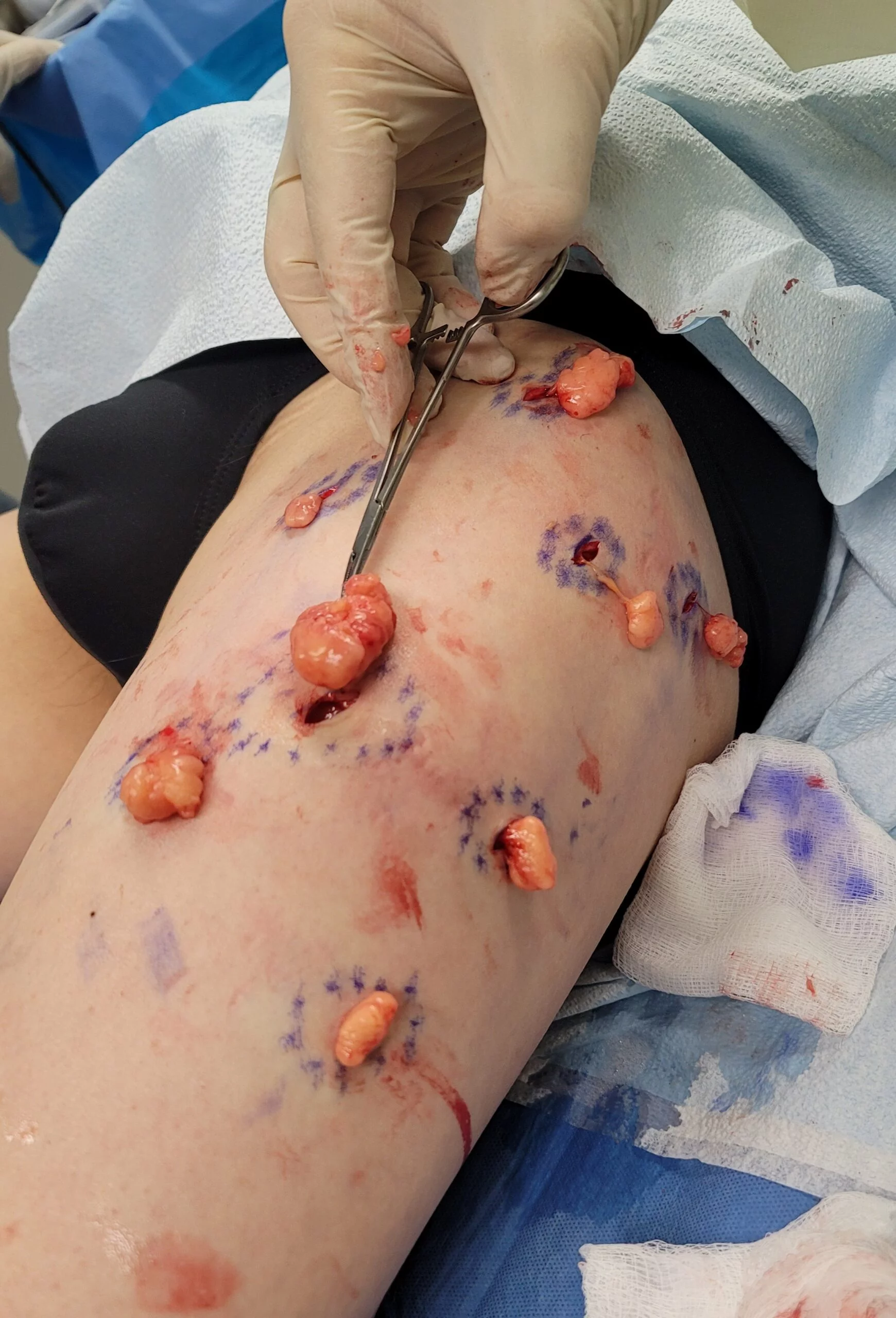 Lipoma Removal