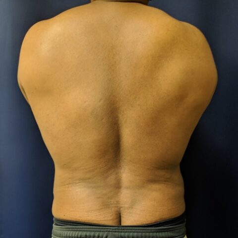 Patient 8284, Flank-Lower Back Liposuction, Male Liposuction Gallery