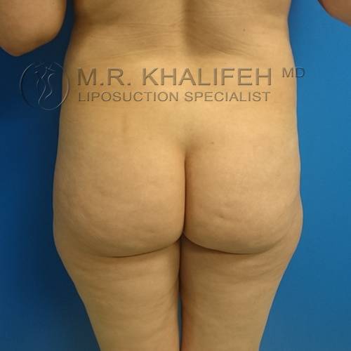 Patient 2866, Midback-Bra Line Liposuction Gallery