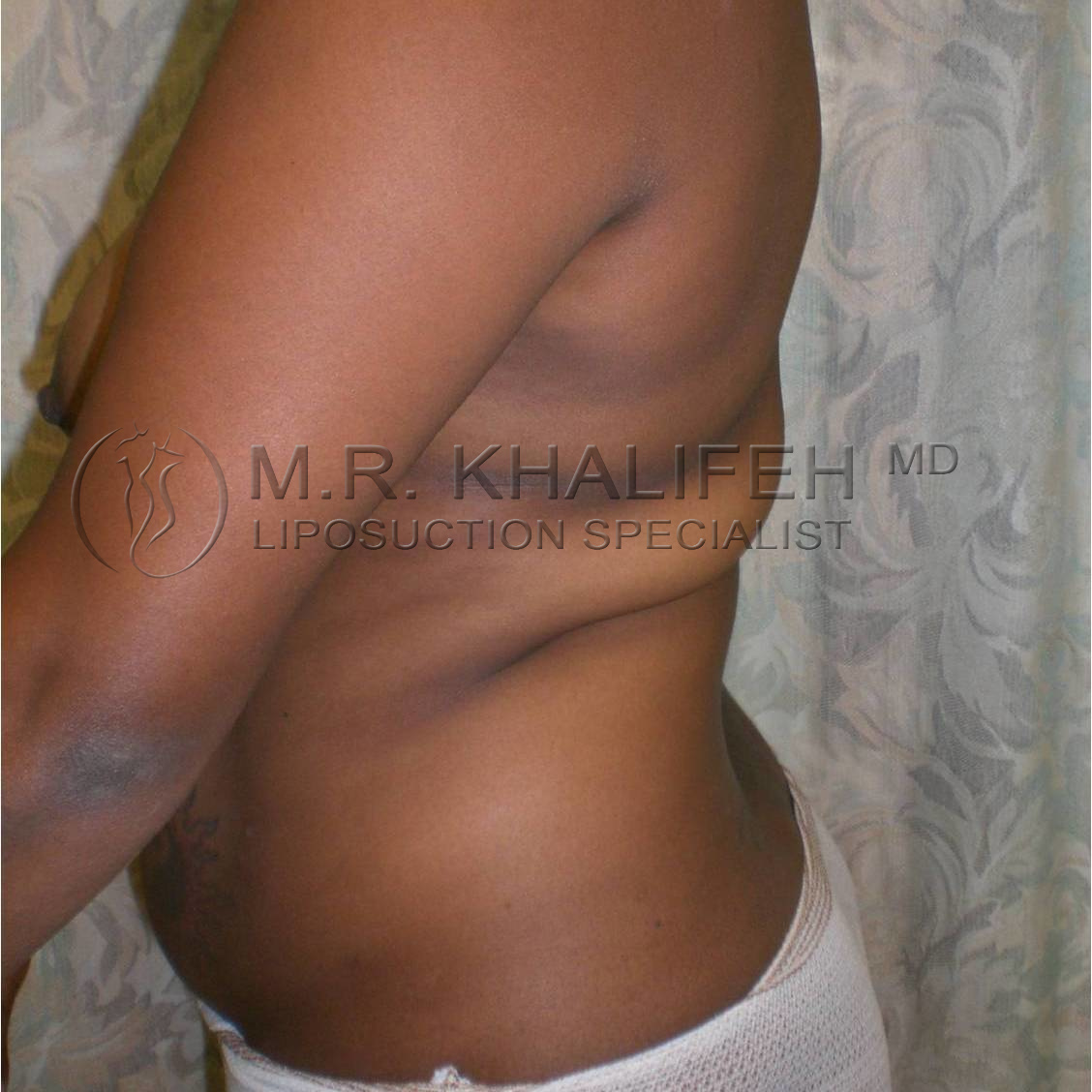 patient shown before back liposuction