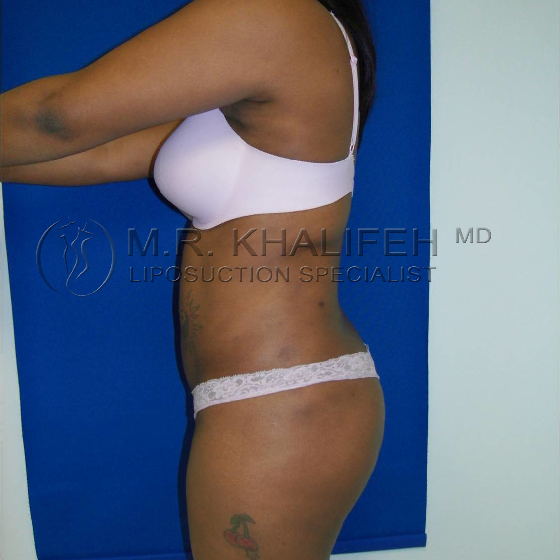 after back liposuction