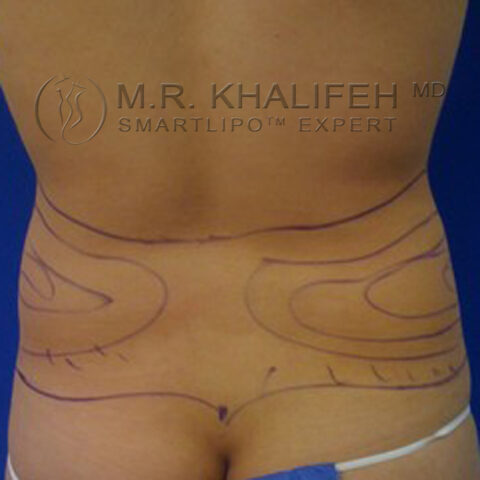 Patient 2866, Midback-Bra Line Liposuction Gallery