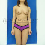 Fat Transfer Breast Augmentation