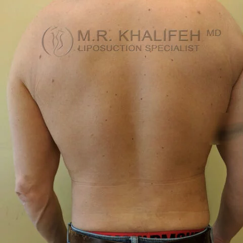 Midback-Bra Line Liposuction Gallery