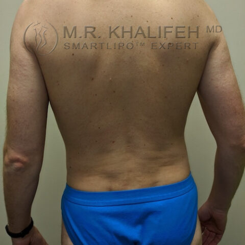 Midback-Bra Line Liposuction Gallery