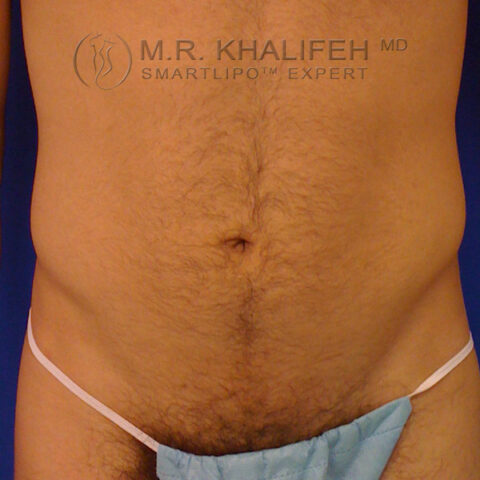 Male Liposuction Gallery