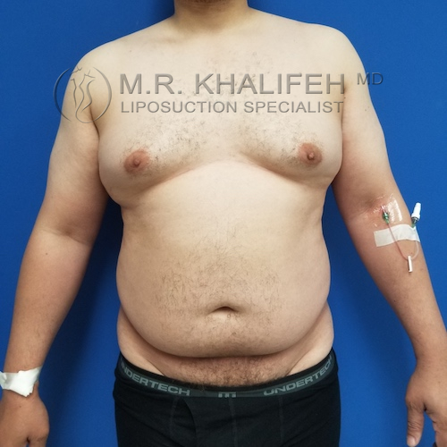 Patient 6540, Male Liposuction Gallery