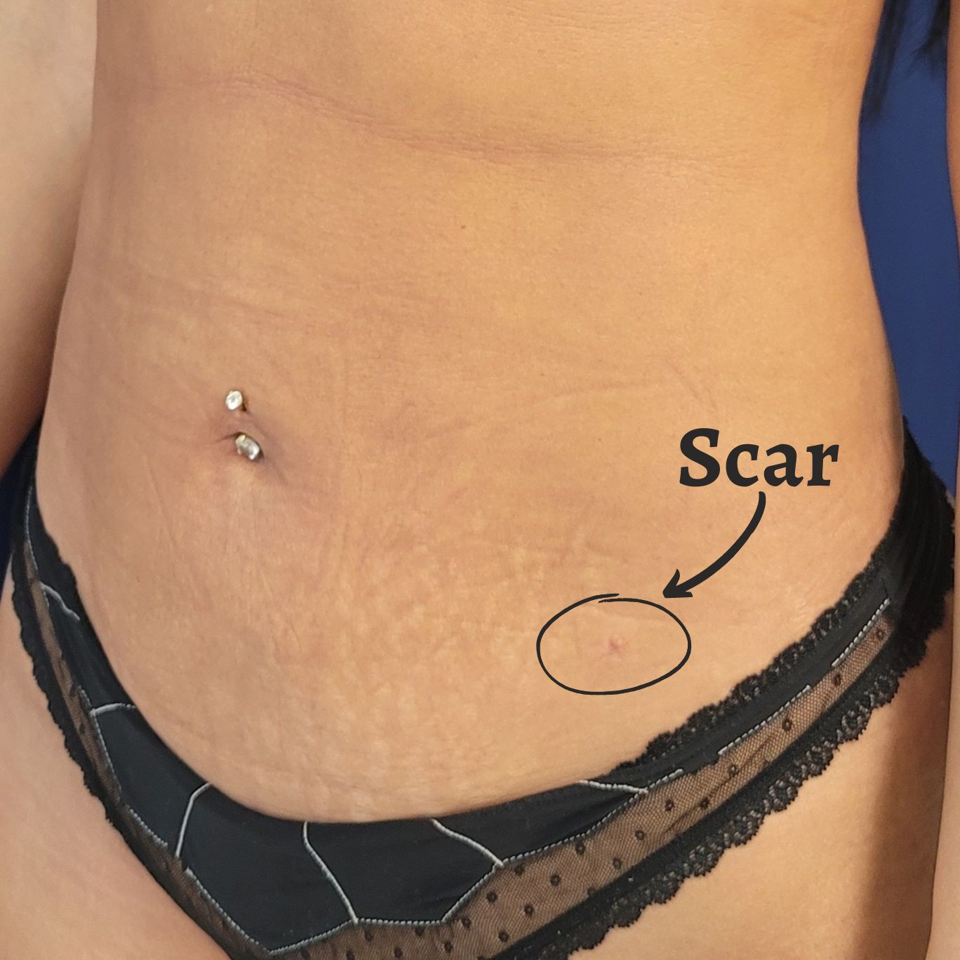 Scar after liposuction procedure