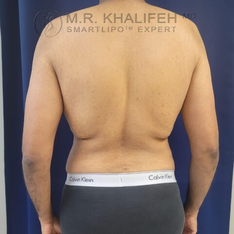 Will Lower Back Liposuction Also Address The Flanks?