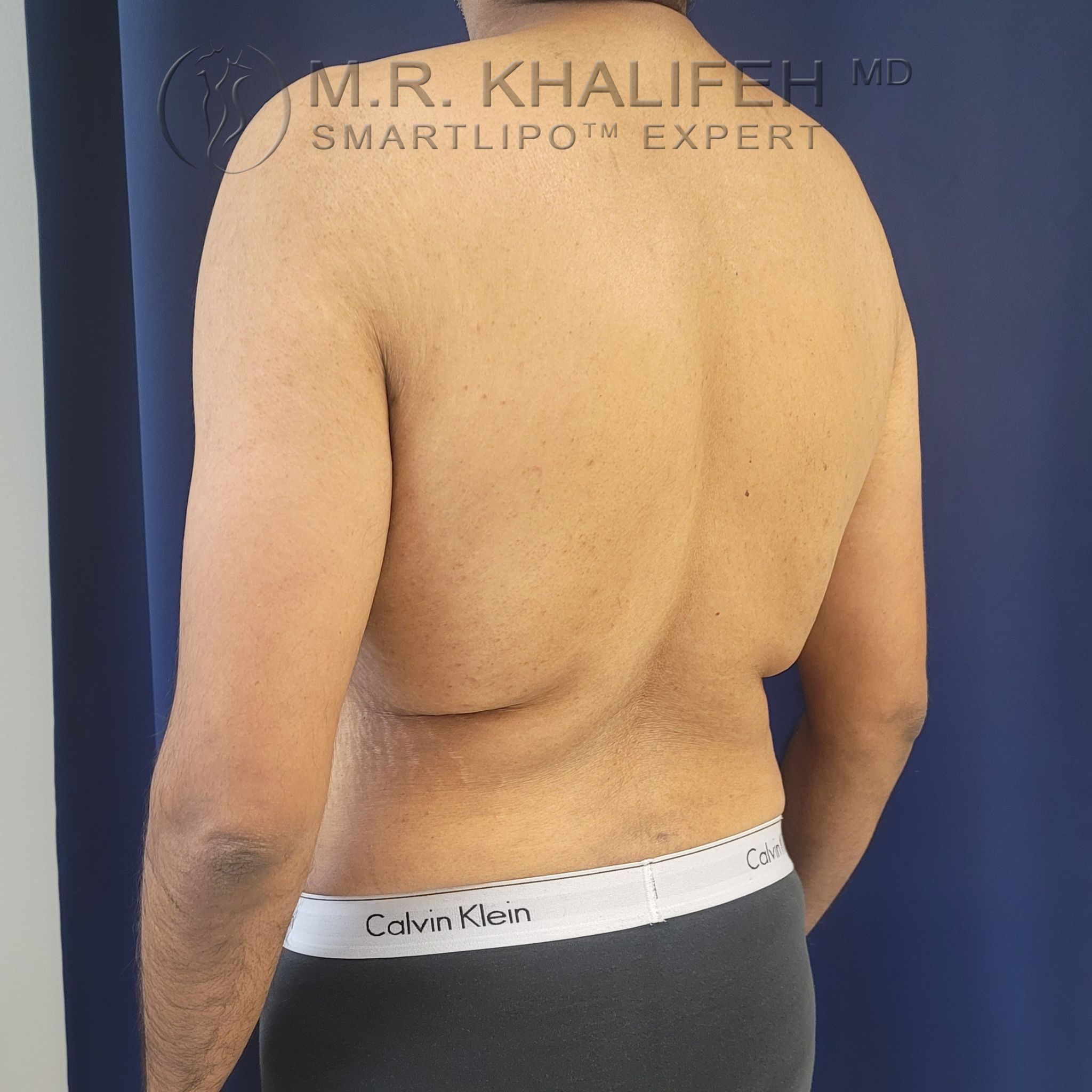 Patient 8284, Flank-Lower Back Liposuction, Male Liposuction Gallery