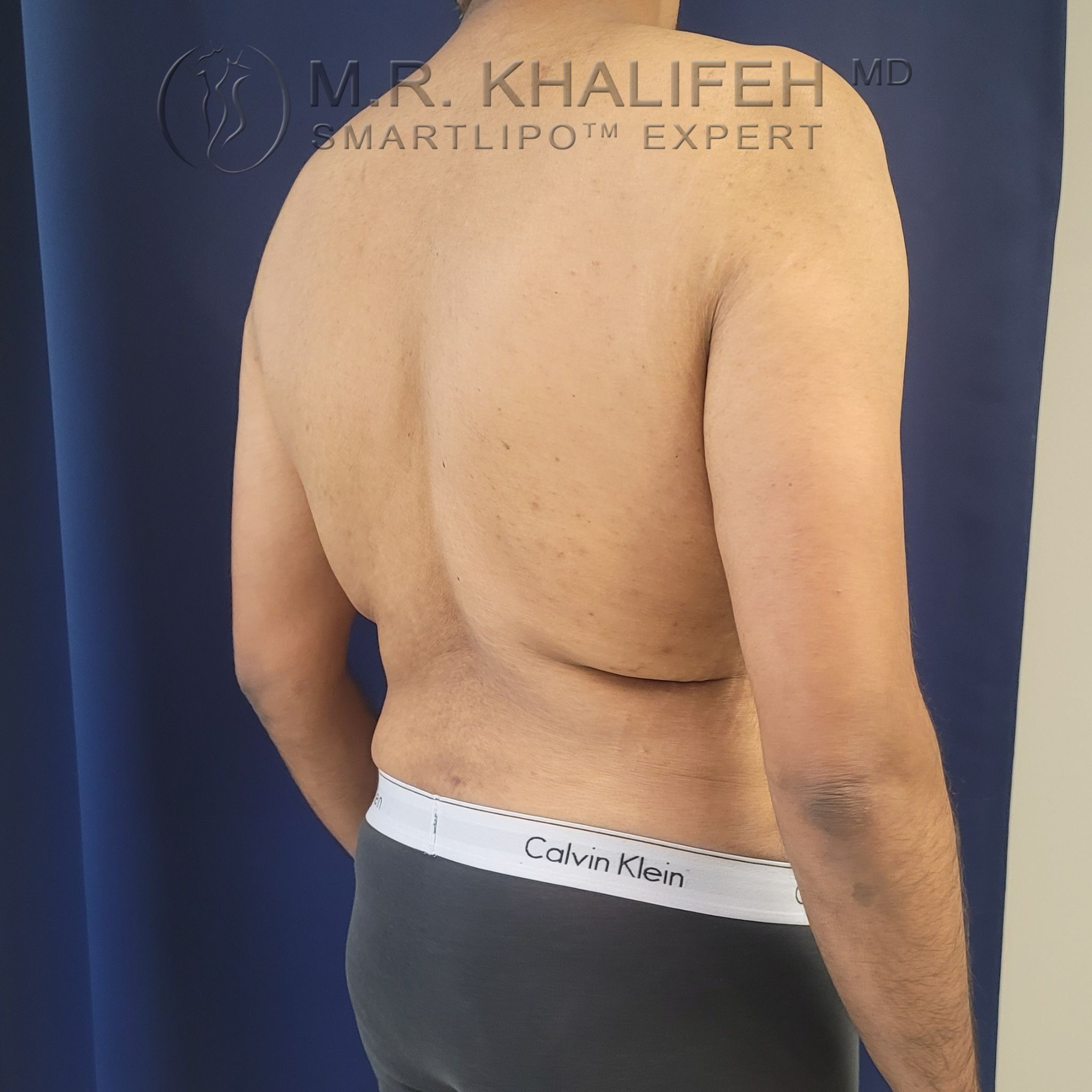 Patient 8284, Flank-Lower Back Liposuction, Male Liposuction Gallery