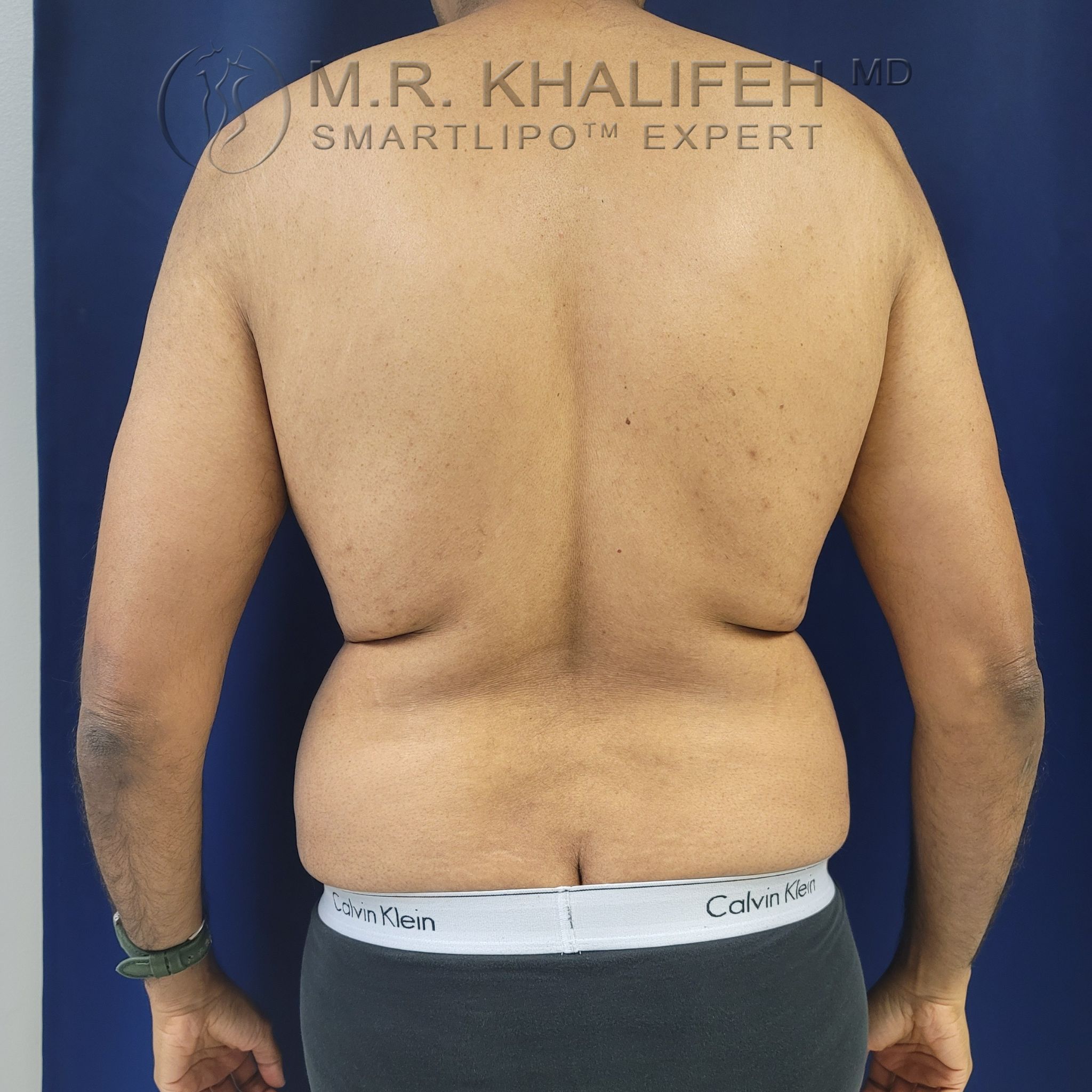 Patient 8284, Flank-Lower Back Liposuction, Male Liposuction Gallery