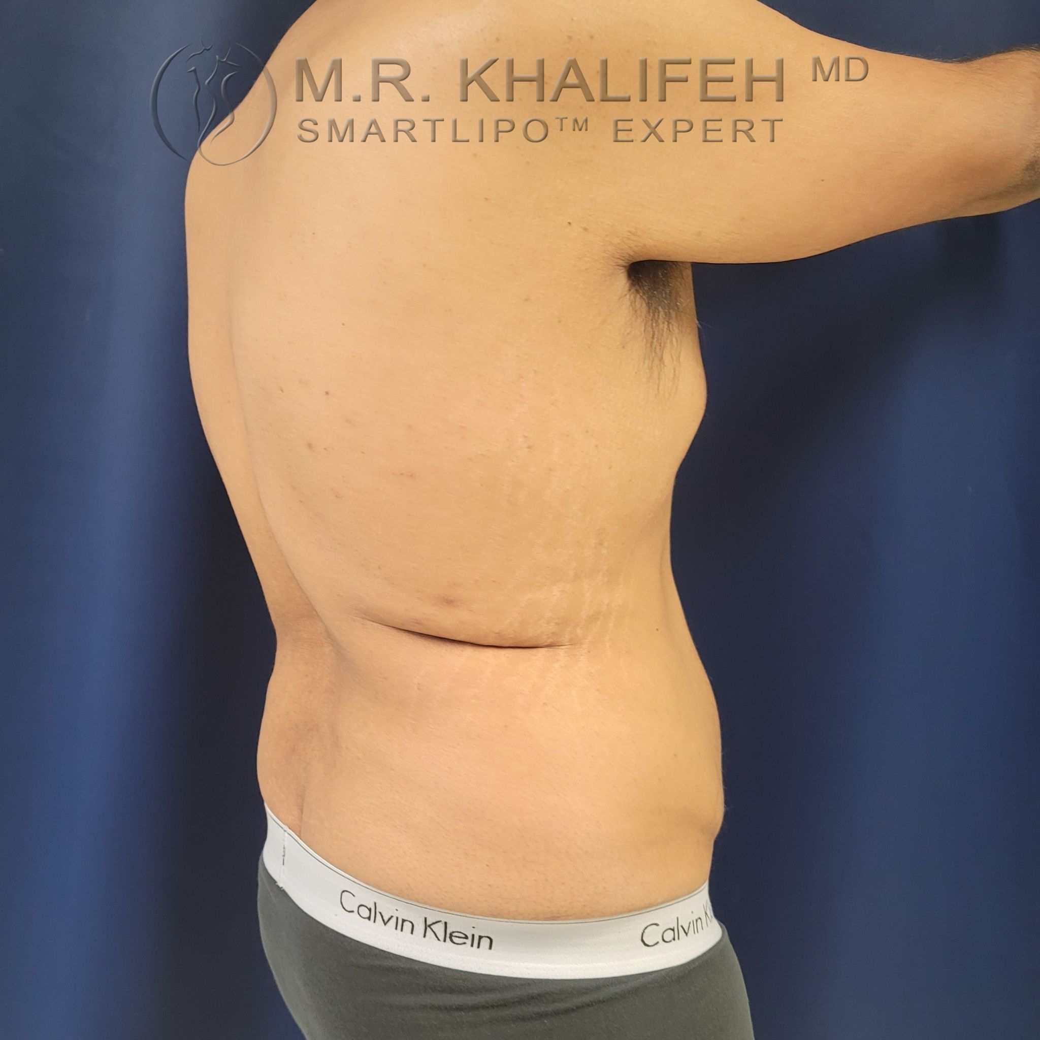 Abdominal Liposuction - KleinLipo - Liposuction Surgery of Orange