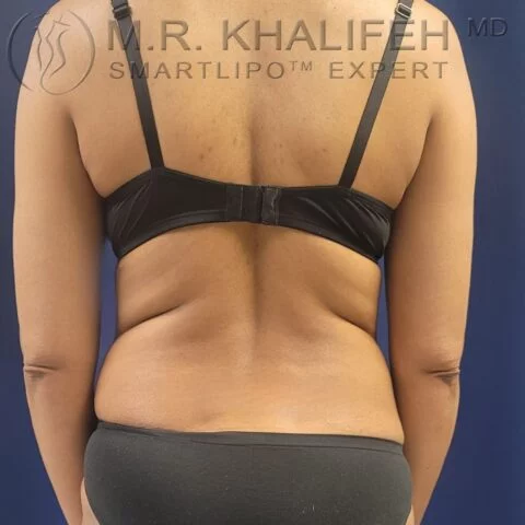 Midback-Bra Line Liposuction Gallery