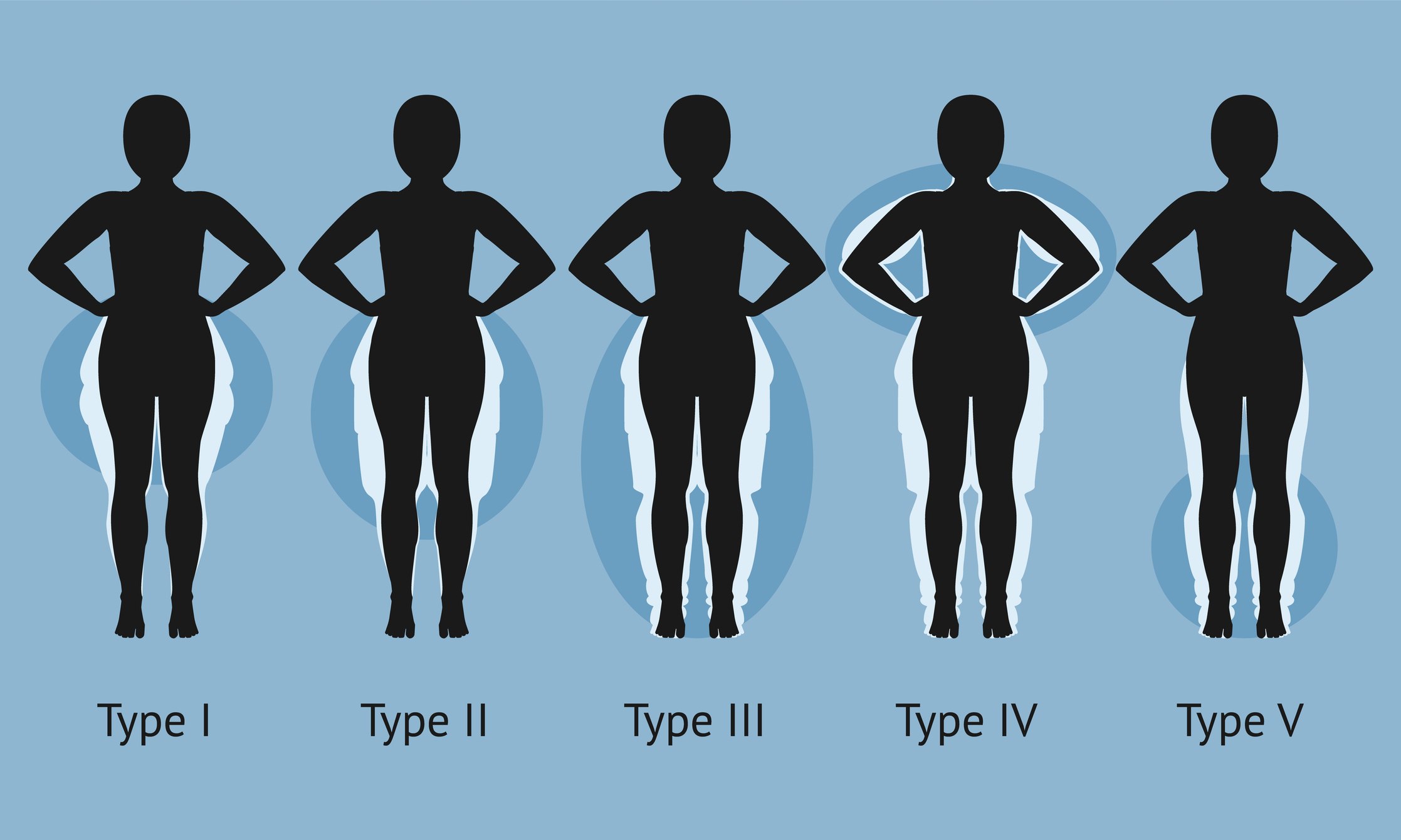 Stages of lipidema