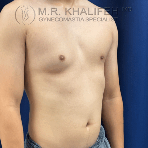 Side view of male chest before treatment for unilateral gynecomastia showing breast tissue enlargement on one side