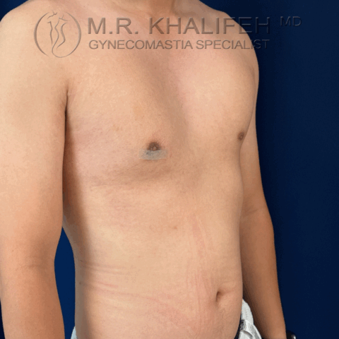 Side view of male chest after treatment for unilateral gynecomastia showing breast tissue enlargement on one side