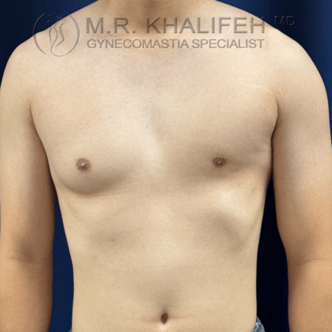 Front view of male chest with unilateral stage II gynecomastia before surgery