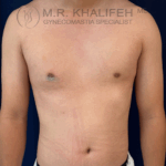 Front view of male chest 8 days after unilateral gynecomastia surgery showing improved symmetry