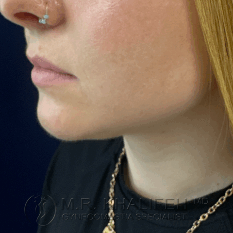 after side view half left chin/neck liposuction