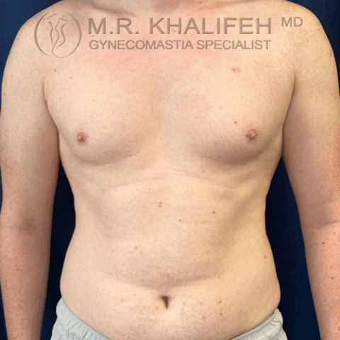 before front gyno