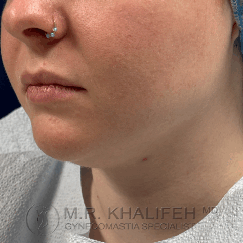 before side view half left chin/neck liposuction