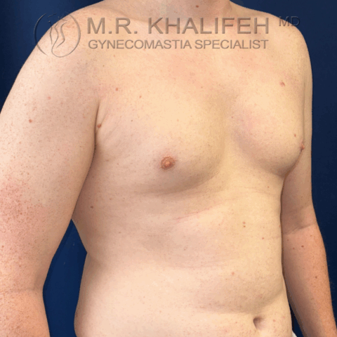 before half side right gyno