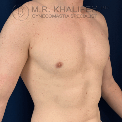 after half side right gyno