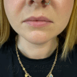 after front view chin/neck liposuction