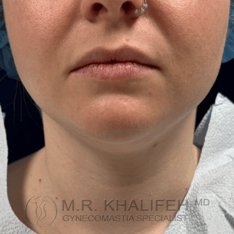 before front view chin/neck liposuction
