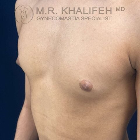 3/4 side left view puffy nipple