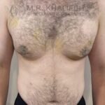 Front view after gynecomastia surgery with reduced skin excess
