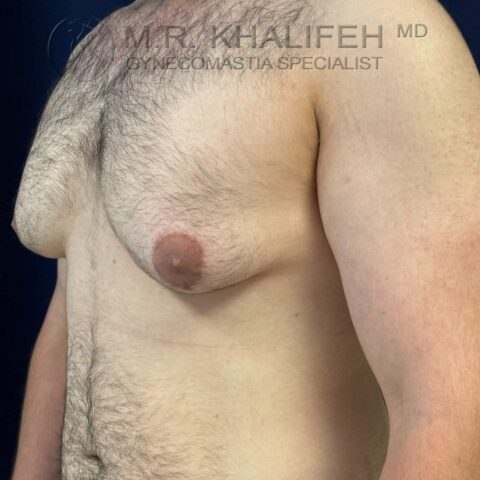 Three-quarter left view before gynecomastia surgery showing skin excess