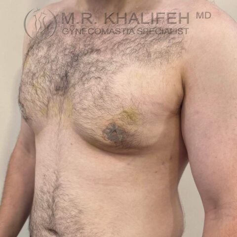 Three-quarter right view after gynecomastia surgery with reduced skin excess