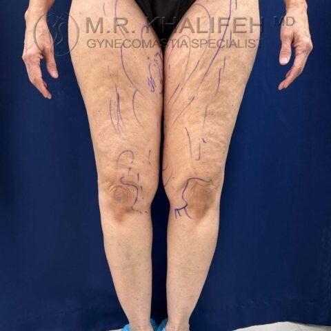 Lipedema before markings front view